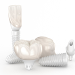 What Are Endosteal Implants?