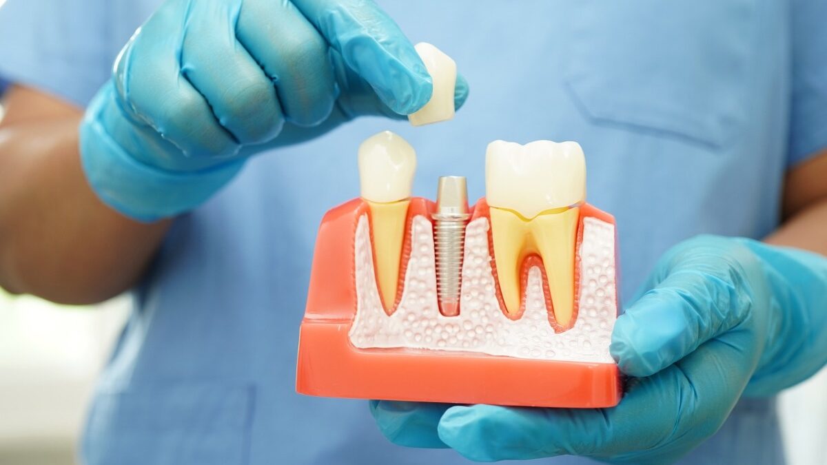 Dental implant stats 2023 - 2024