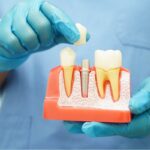 Dental implant stats 2023 - 2024