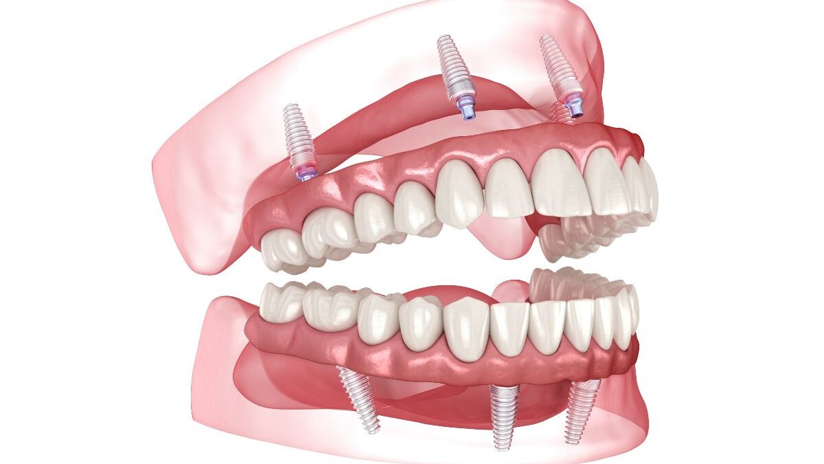 What is All On Four Dental Implants Treatment?