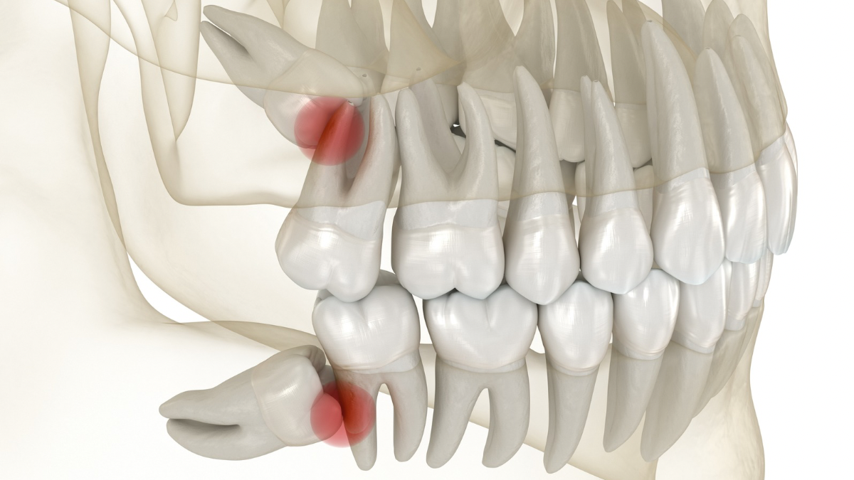 How common is wisdom tooth removal?