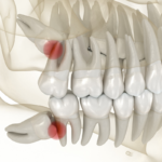 How common is wisdom tooth removal?
