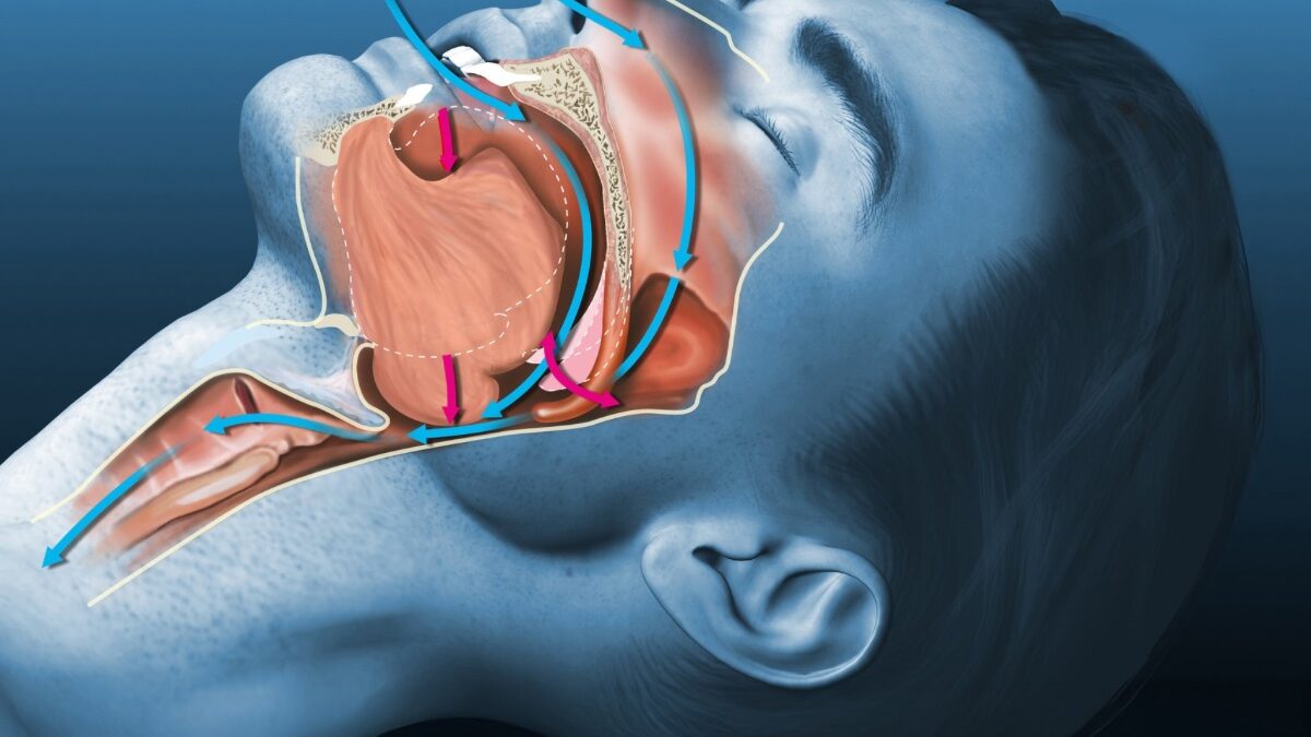 Sleep Apnea and Oral Health; How Sleep Apnea Affects Your Oral Health
