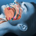 Sleep Apnea and Oral Health; How Sleep Apnea Affects Your Oral Health