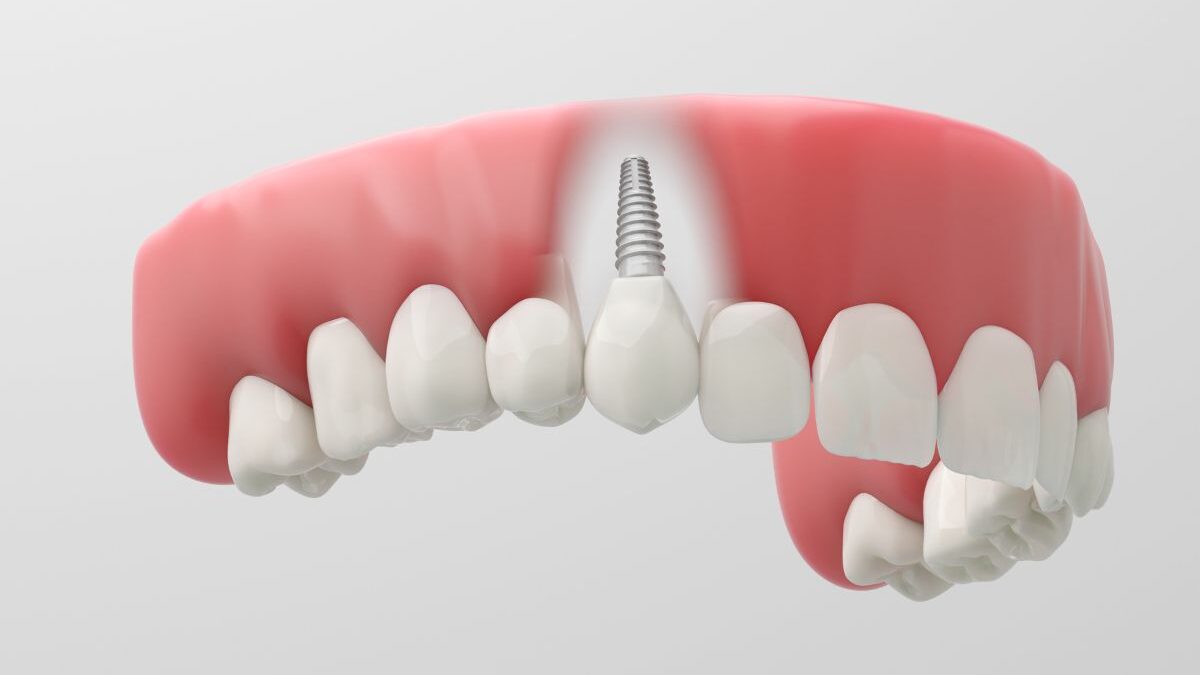 The Biocompatibility of Zirconia Dental Implants