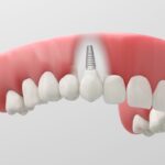 The Biocompatibility of Zirconia Dental Implants