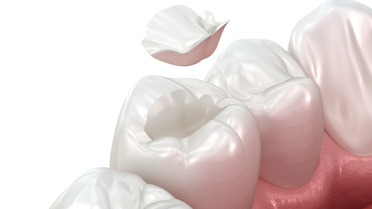 The Growing Demand for Mercury-Free and BPA-Free Dental Fillings