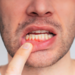 Periodontitis, Symptoms, Causes & Treatments