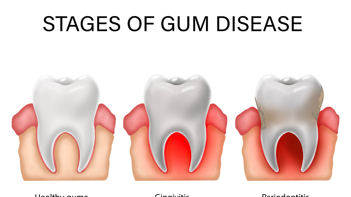 Stages of Periodontal Disease - Healthy gums, gingivitis & periodontitis