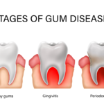 Stages of Periodontal Disease - Healthy gums, gingivitis & periodontitis
