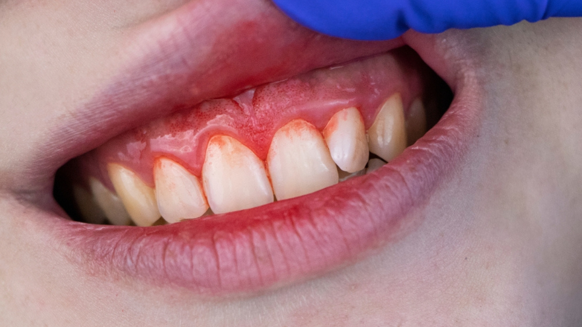 Top 5 periodontitis home remedies
