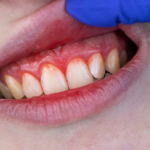 Top 5 periodontitis home remedies