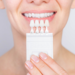 Smiling woman showcasing her perfect smile after porcelain veneers treatment at a dental clinic.