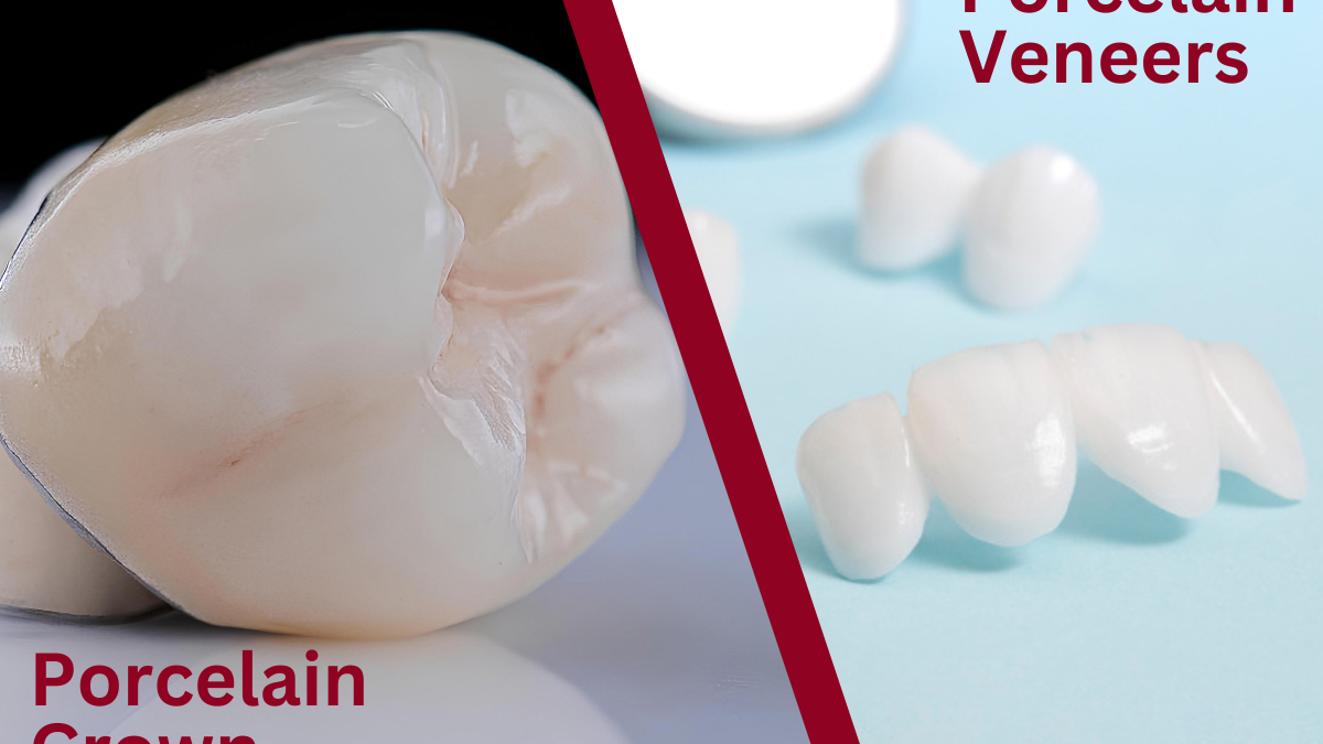 porcelain crowns vs porcelain veneers