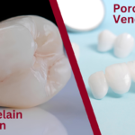 porcelain crowns vs porcelain veneers
