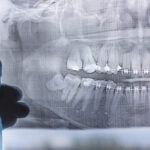 Do I Need to Have My Wisdom Teeth Removed?