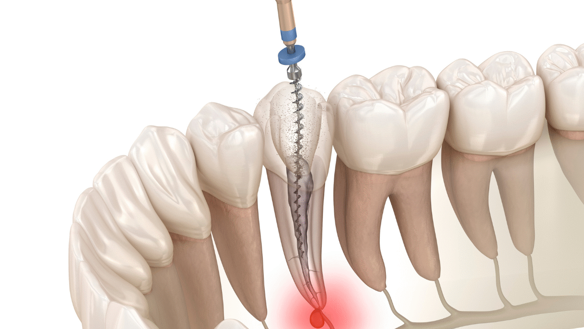 Root Canal Treatment Side Effects and Complications
