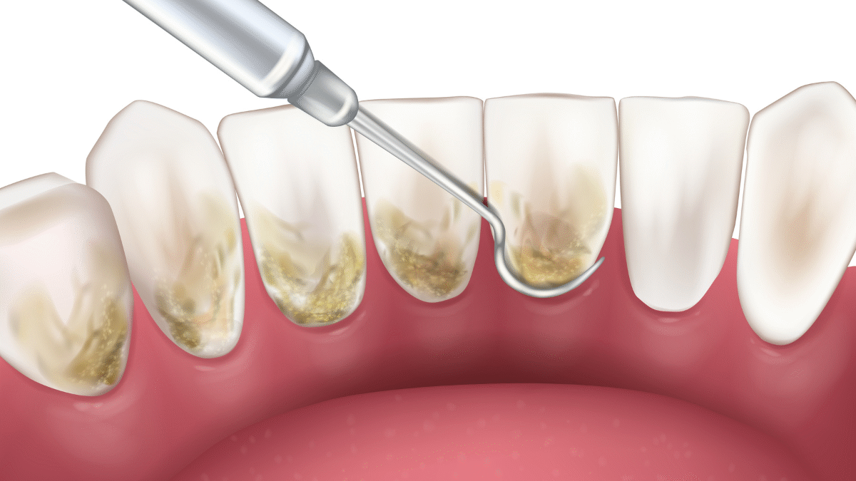 Deep Dental Cleaning, What You Need To Know