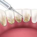 Deep Dental Cleaning, What You Need To Know