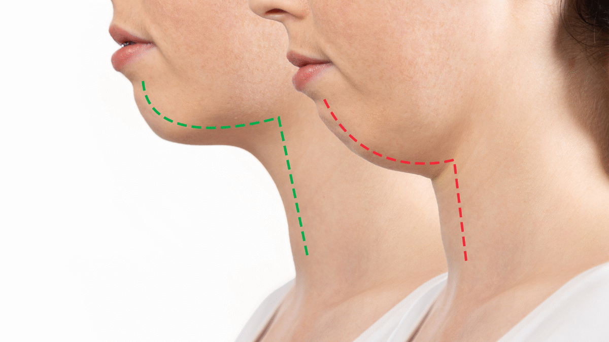 what is bite correction and why is it important?
