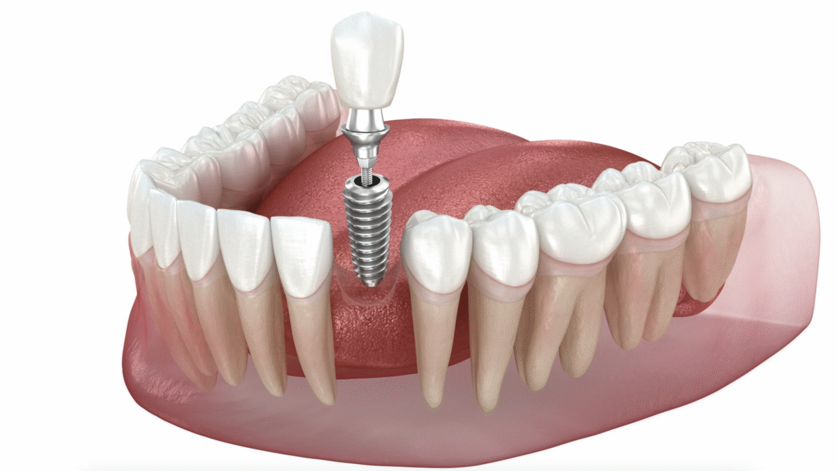 Metal Implant Removal - Purpose and Procedure