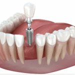 Metal Implant Removal - Purpose and Procedure