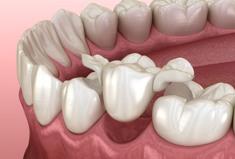 Alternatives To Dental Implants, What Are Your Other Options?