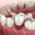 Alternatives To Dental Implants, What Are Your Other Options?