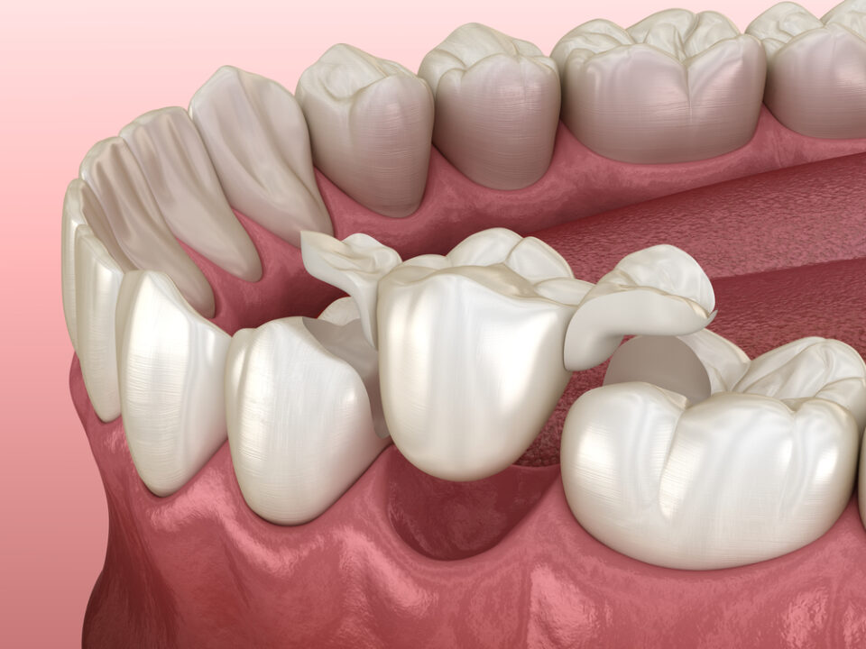 Alternatives To Dental Implants, What Are Your Other Options?