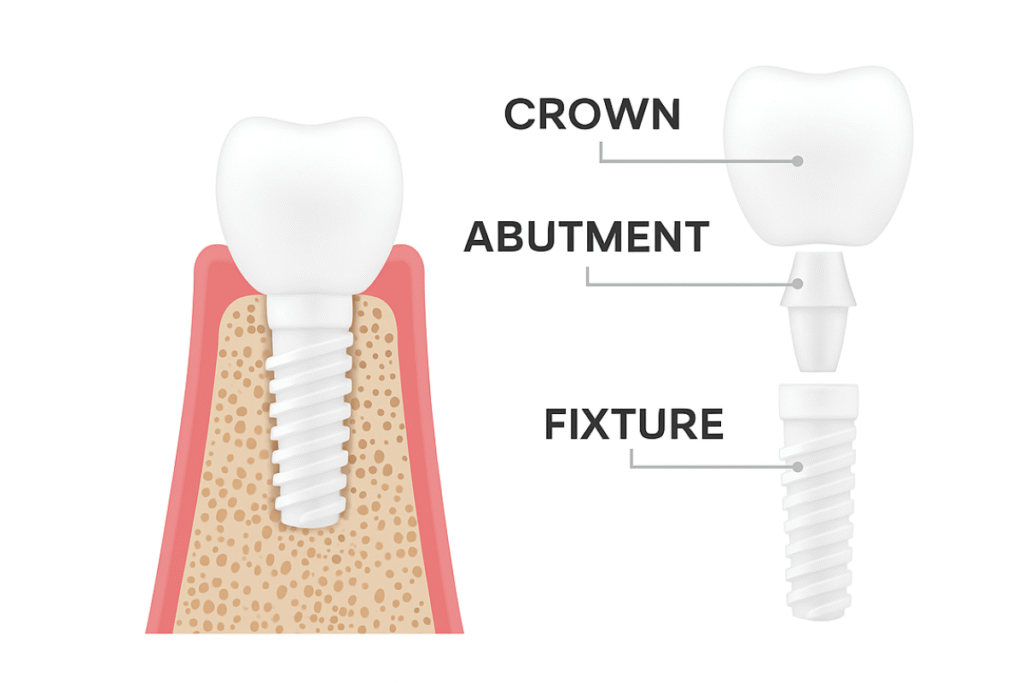 The Components of dental implants - abutment