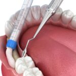 What is Dental Bone Graft?