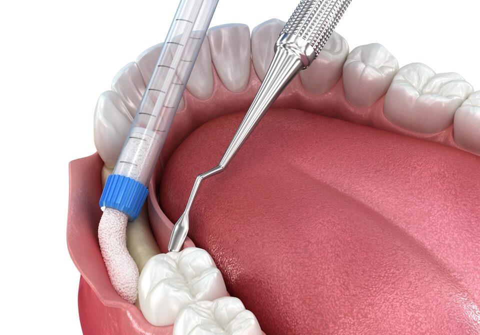 What is Dental Bone Graft?