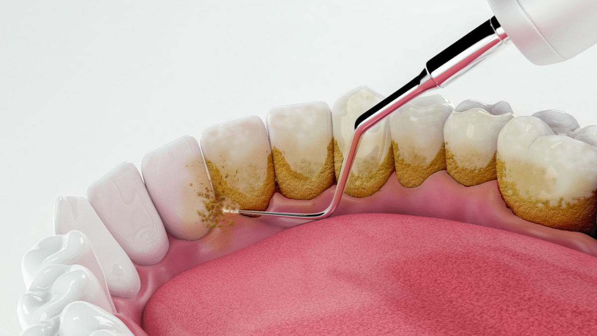 Deep Dental Cleaning, What It Is and Why You Probably Need It 4 Deep Dental Cleaning, What It Is and Why You Probably Need It