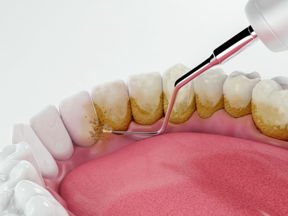 Deep Dental Cleaning, What It Is and Why You Probably Need It