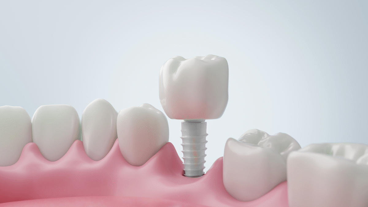 Top 7 Reasons to Choose Zirconia Teeth Implants in Orange County for a Healthier, Metal-Free Smile 4 Top 7 Reasons to Choose Zirconia Teeth Implants