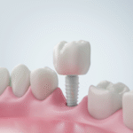 Top 7 Reasons to Choose Zirconia Teeth Implants in Orange County for a Healthier, Metal-Free Smile 5 Top 7 Reasons to Choose Zirconia Teeth Implants