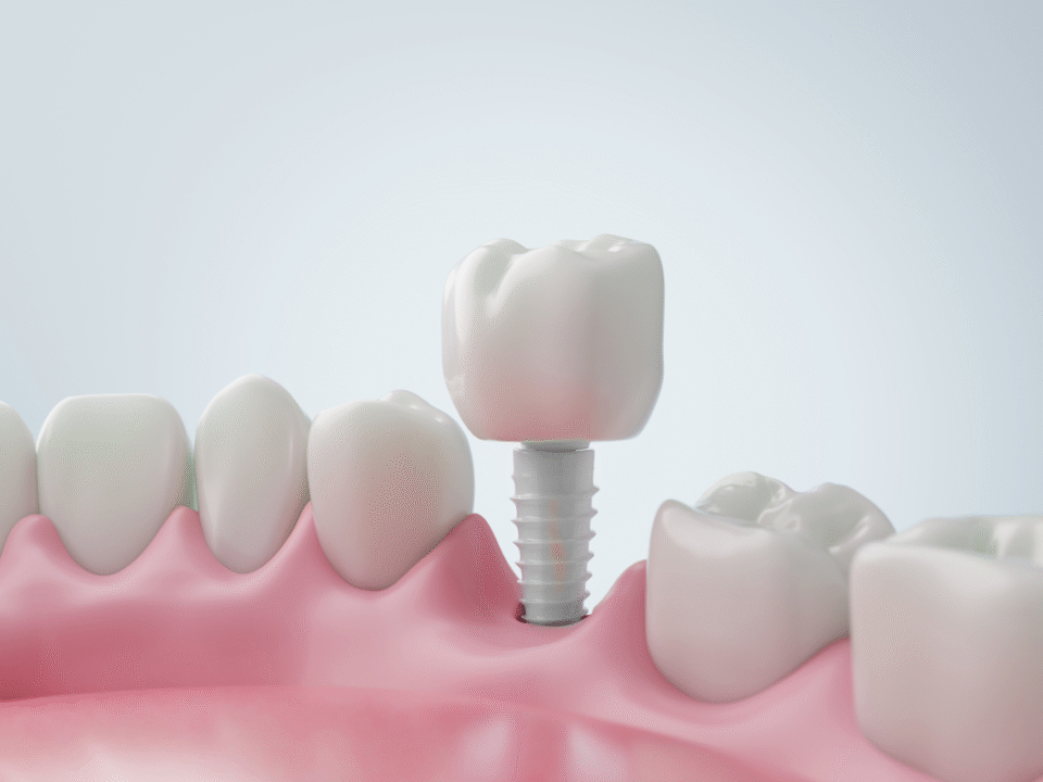 Top 7 Reasons to Choose Zirconia Teeth Implants in Orange County for a Healthier, Metal-Free Smile 11 Top 7 Reasons to Choose Zirconia Teeth Implants