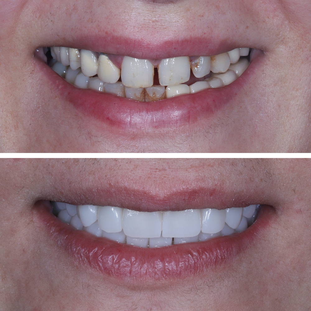 Top 7 Reasons to Choose Zirconia Teeth Implants in Orange County for a Healthier, Metal-Free Smile 6 zirconia dental implant before - after