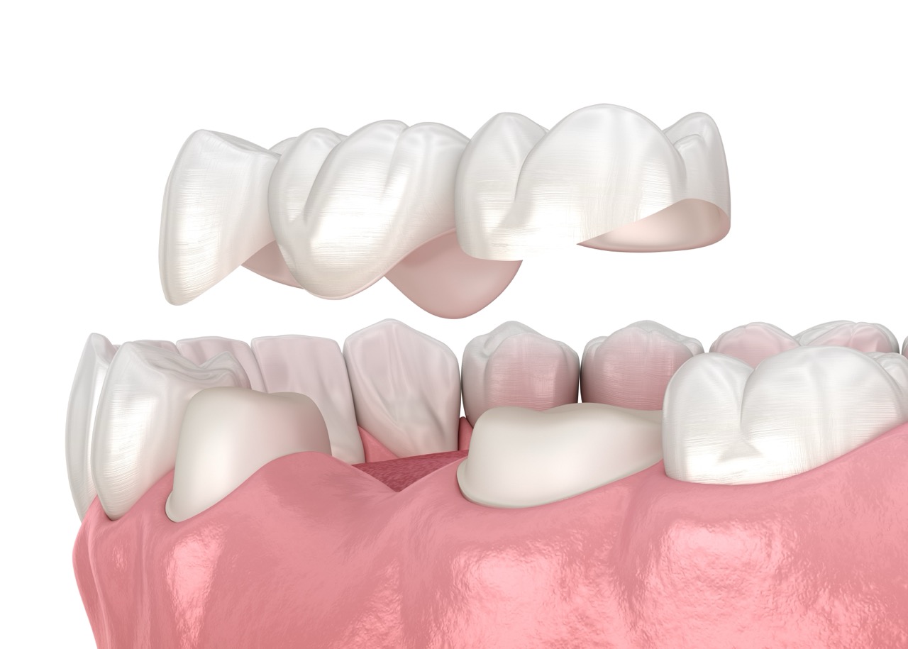Zirconia Crown – Natural, Metal-Free, and Long-Lasting Smile Restoration