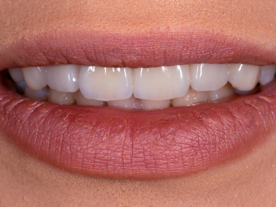 How Long Do Zirconia Crowns Last? A Comprehensive Guide to Their Lifespan & Durability 2 How Long Do Zirconia Crowns Last A Comprehensive Guide to Their Lifespan & Durability