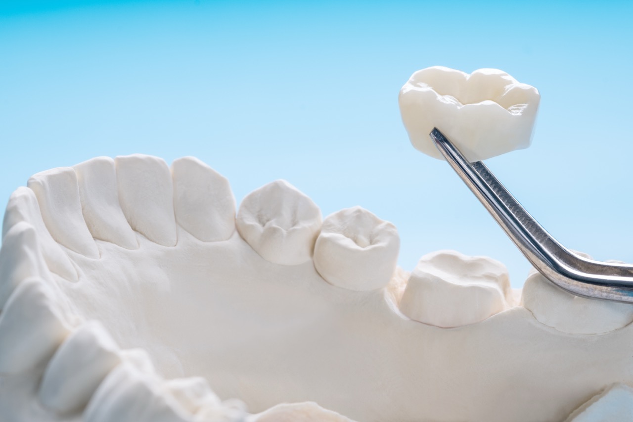 Porcelain Crowns – Natural, Beautiful & Holistic Tooth Restoration in Orange County