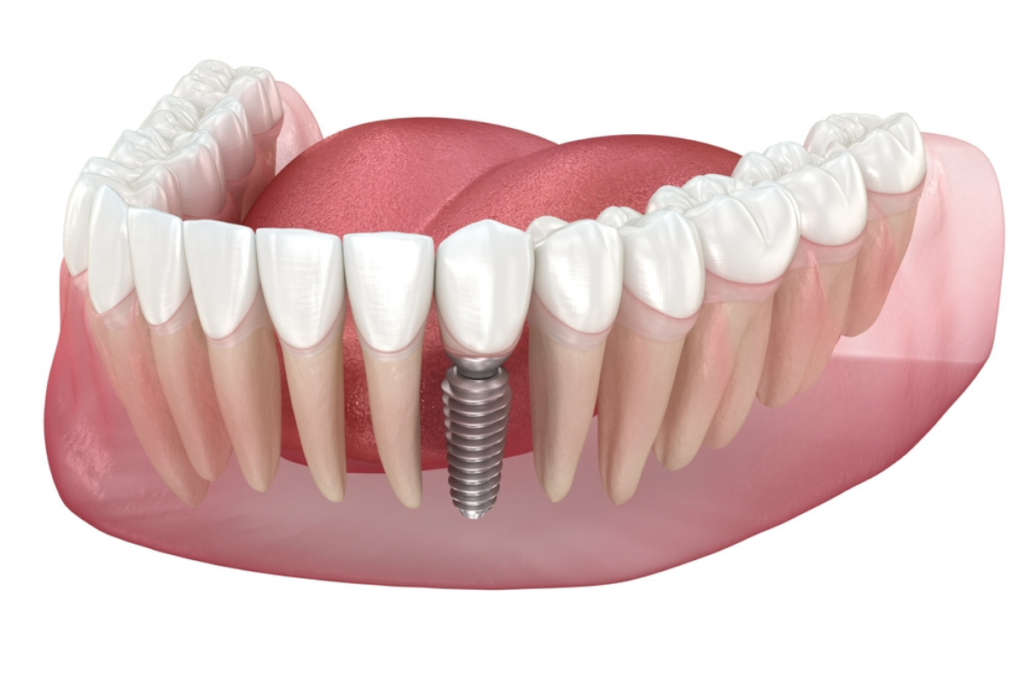 What Are Screwless Dental Implants? A Complete Guide to This Modern Tooth Replacement 1 Screwless Dental Implants