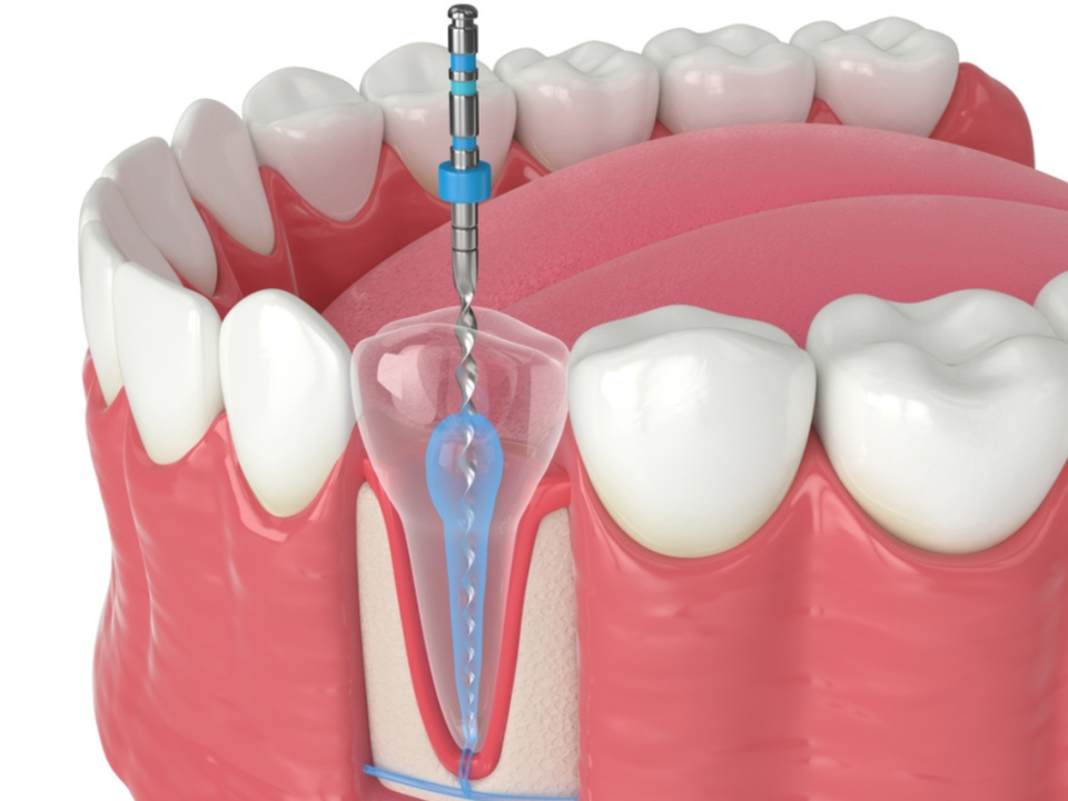 The Hidden Risks of Root Canal Therapy: What Most Patients Don’t Know 6 The Hidden Risks of Root Canal Therapy What Most Patients Don’t Know