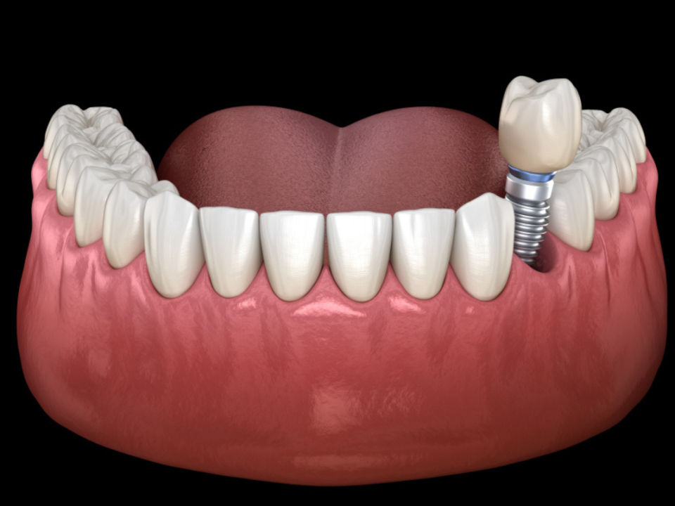What Are Screwless Dental Implants? A Complete Guide to This Modern Tooth Replacement 6 What Are Screwless Dental Implants_ A Complete Guide to This Modern Tooth Replacement