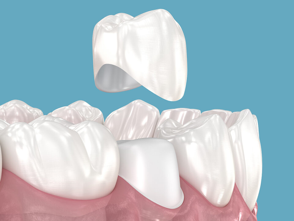 Zirconia Crown vs Porcelain: Find Out Which Option Looks More Natural 4 Zirconia Crown vs Porcelain: Find Out Which Option Looks More Natural