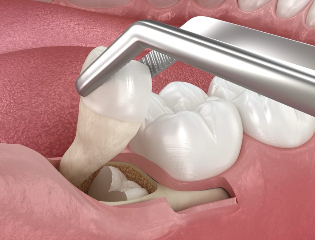 The Link Between Holistic Tooth Extraction and Chronic Illness Prevention 1 Dental extraction procedure illustration showing removal of an infected tooth from the jaw, commonly performed before dental implant or restorative treatment.