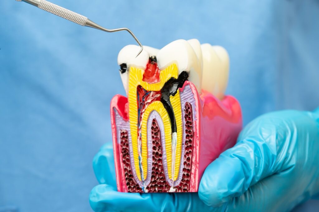Is Root Canal Treatment Safe? A Holistic and Biological Perspective on Root Canal Treatment 1 dentist holding dental implant, artificial tooth roots into jaw, root canal of dental treatment, gum disease, teeth model for dentist.