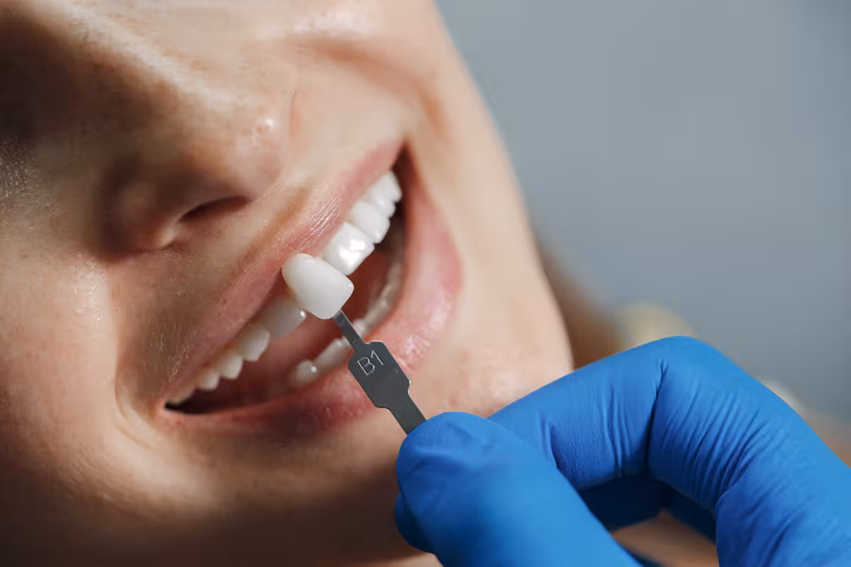 Full Mouth Reconstruction