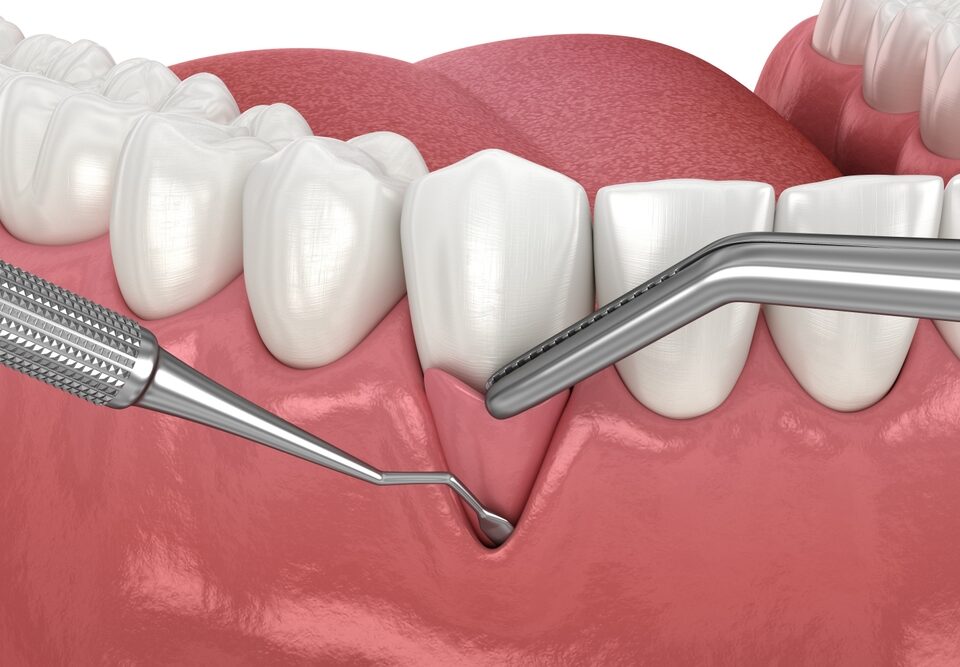 When Is It Too Late for Gum Grafting? The Truth Every Patient Should Know