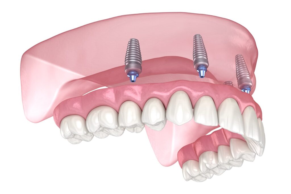 Are You a Candidate for an All-on-4 Bridge? Everything You Need to Know 2 3d model of all-on-4 Bridge upper jaw